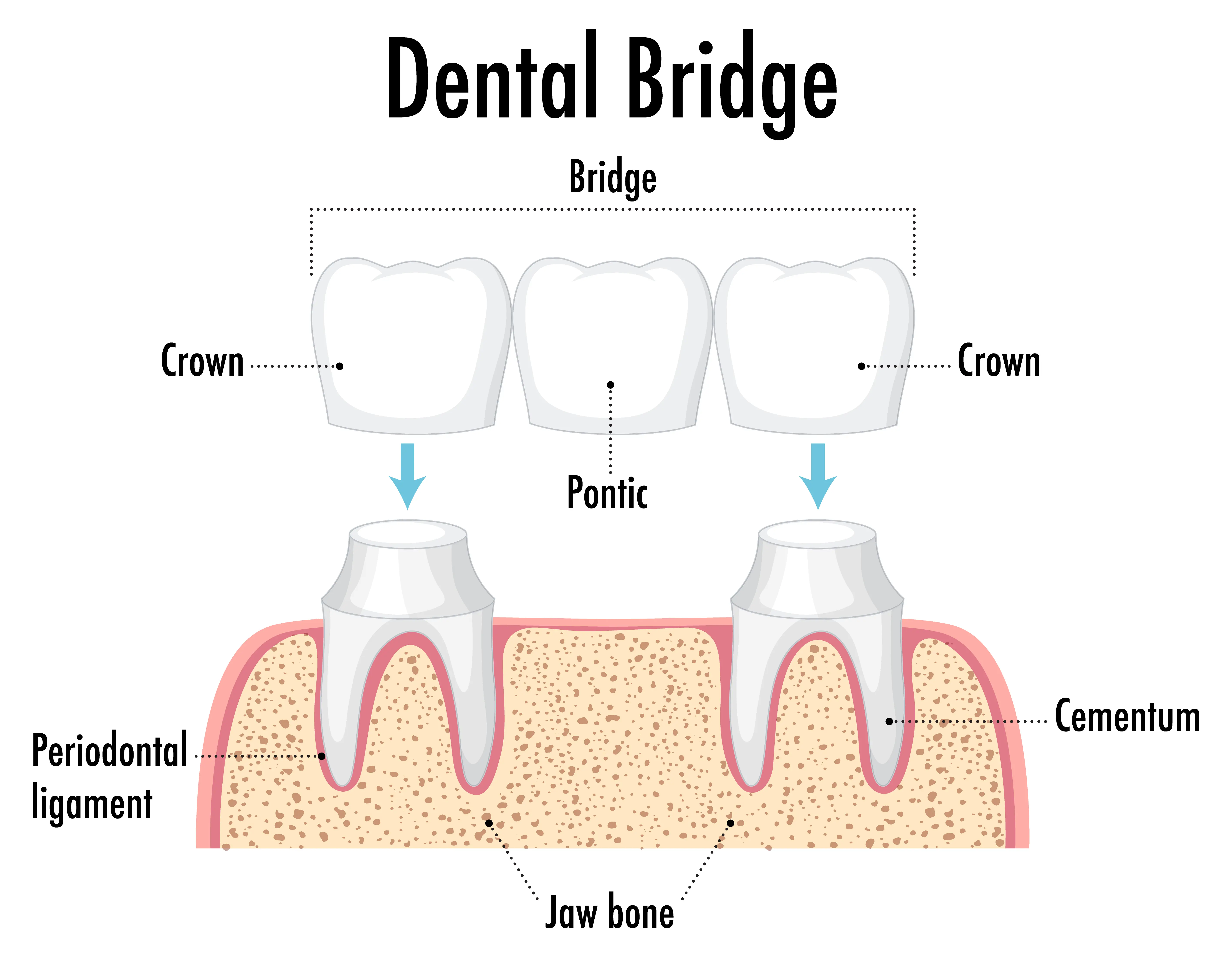 Dental Bridges